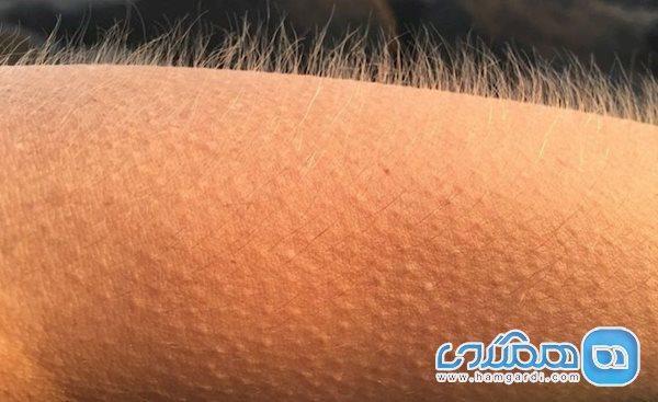مورمور شدن و چند حقیقت جالب درباره این واکنش عجیب بدن که مورمور شدن و چند حقیقت جالب درباره این واکنش عجیب بدن که نمی دانستید