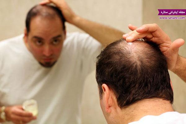 درمان ریزش مو در طب سنتی برای مردان