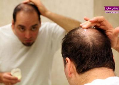 درمان ریزش مو در طب سنتی برای مردان